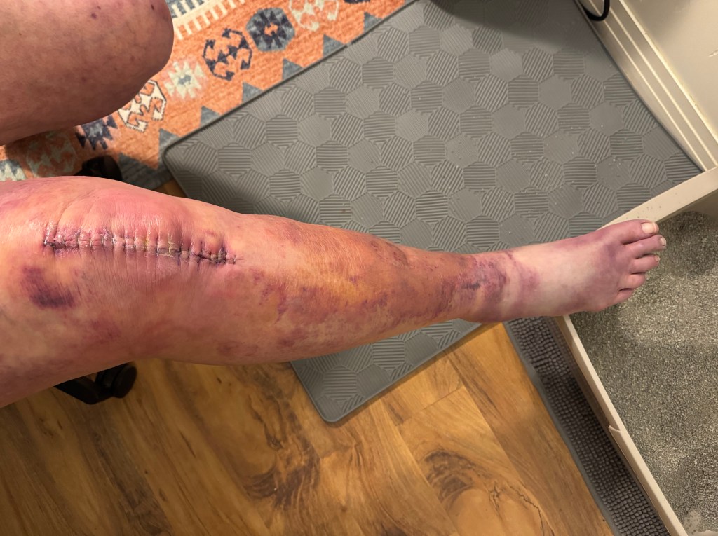 Close-up of a leg with visible surgical stitches and bruising post-operation.