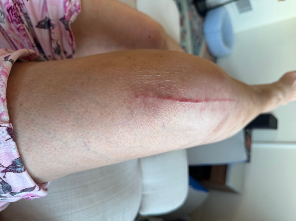 A close-up of a leg showing a long surgical scar on the shin area. The skin tone is light, and the scar appears red against the surrounding skin.